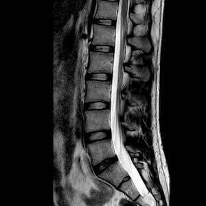 stem cell treatment in spine in Germany