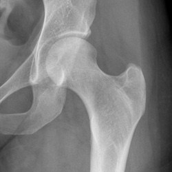 best hospitals in Germany for total hip replacement surgery