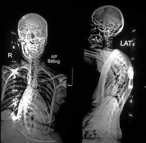 kyphoscoliosis surgery in Germany