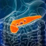 pancreatic cancer treatment in Germany